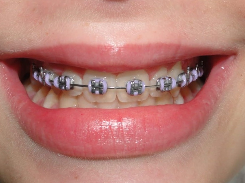 Aparelho ortodôntico fixo com borrachinhas lilás instalado nos dentes