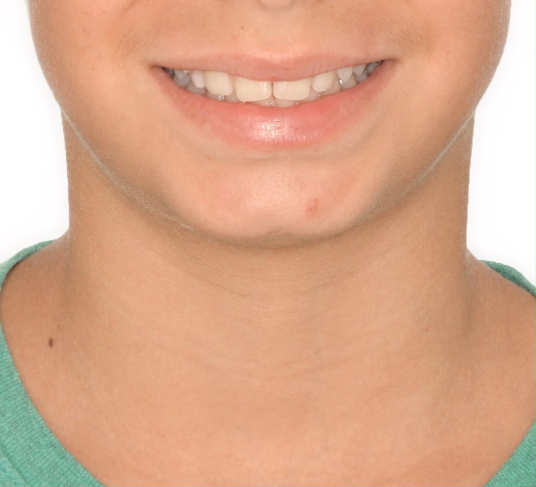 Sorriso de criança durante a fase de troca dos dentes